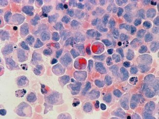 18 pacientes, todos curados: la prometedora pastilla experimental contra la leucemia más agresiva