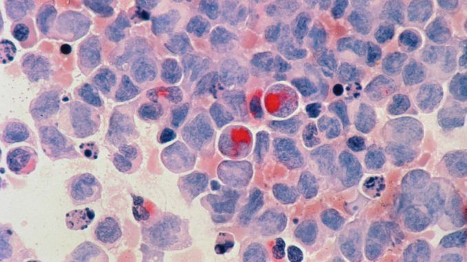18 pacientes, todos curados: la prometedora pastilla experimental contra la leucemia más agresiva